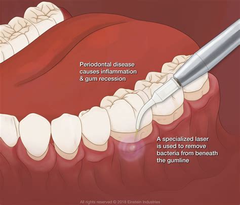 Gum Disease Treatment .